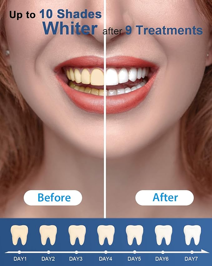 Teeth Whitening - Image 3