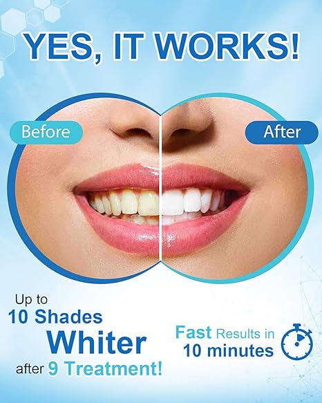 Teeth Whitening - Image 4